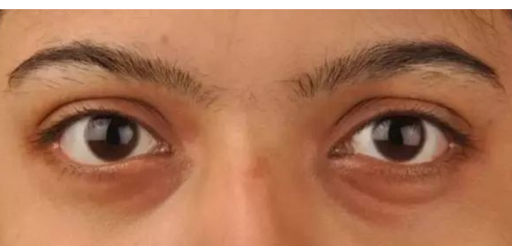 去黑眼圈的眼霜哪款好（黑眼圈用什么眼霜最好）(11)